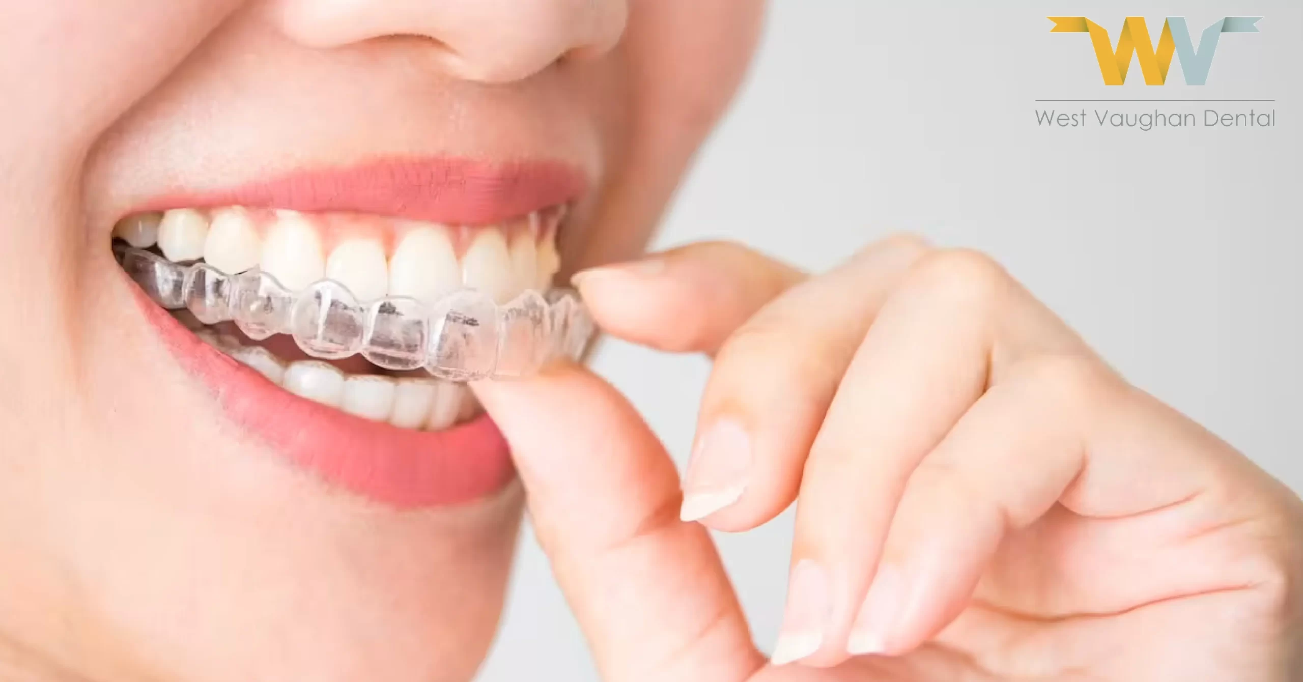 7 Benefits of Getting Invisalign Treatment