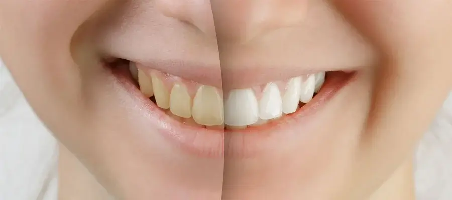 Toronto-area Cosmetic Dentist Provides Tips For Keeping Your Smile White