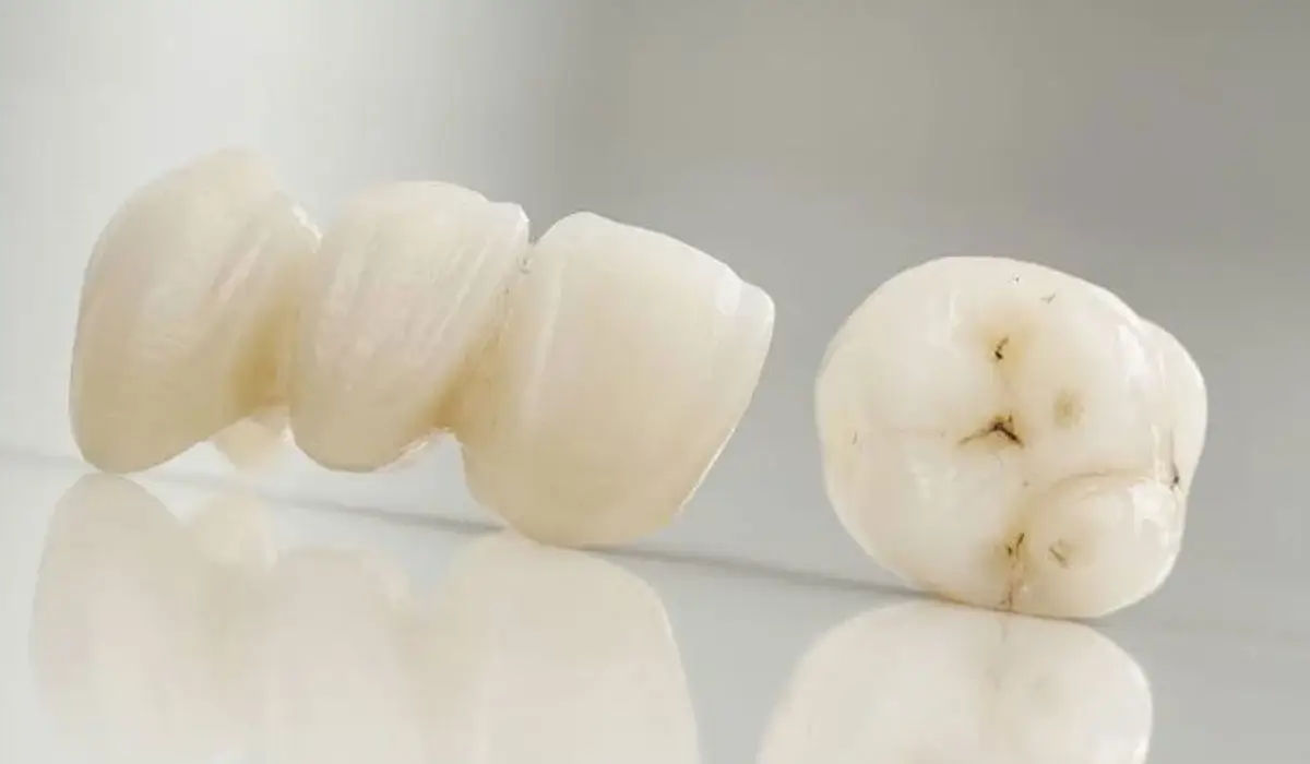 Woodbridge, ON patients ask, “Where can I find porcelain crowns for teeth near me?”