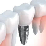 Dental Implants For Patients In Toronto Provide A Solid Tooth Replacement Solution
