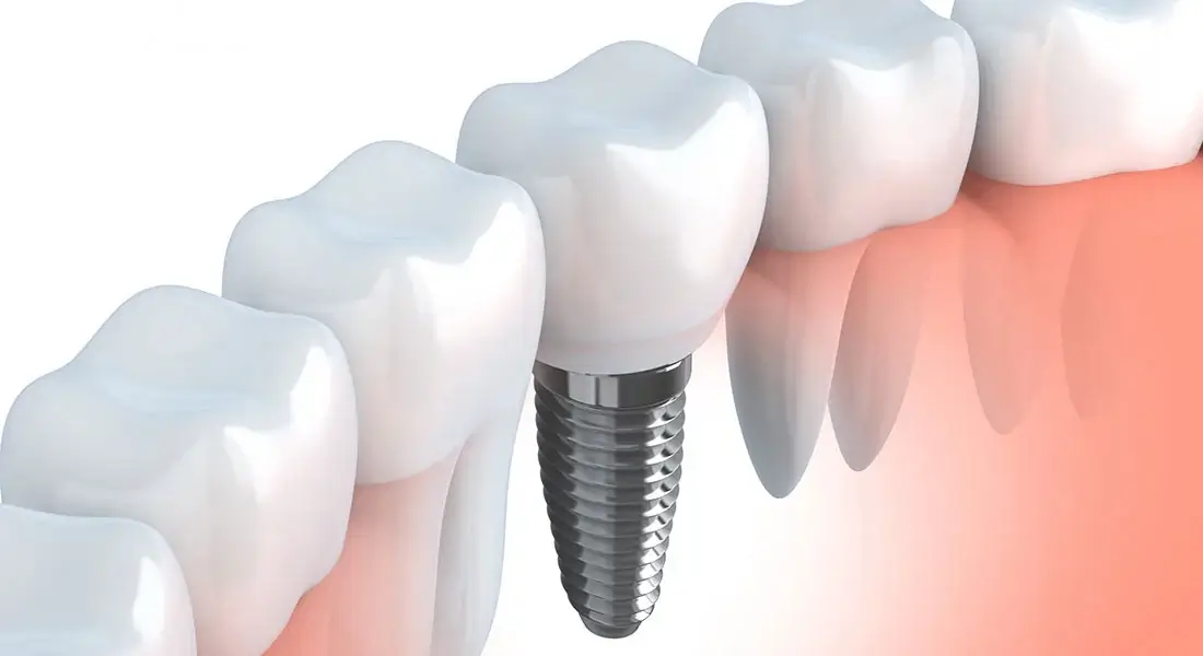 Dental Implants For Patients In Toronto Provide A Solid Tooth Replacement Solution