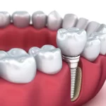 Woodbridge, ON area dentist describes the purpose of root canals treatment