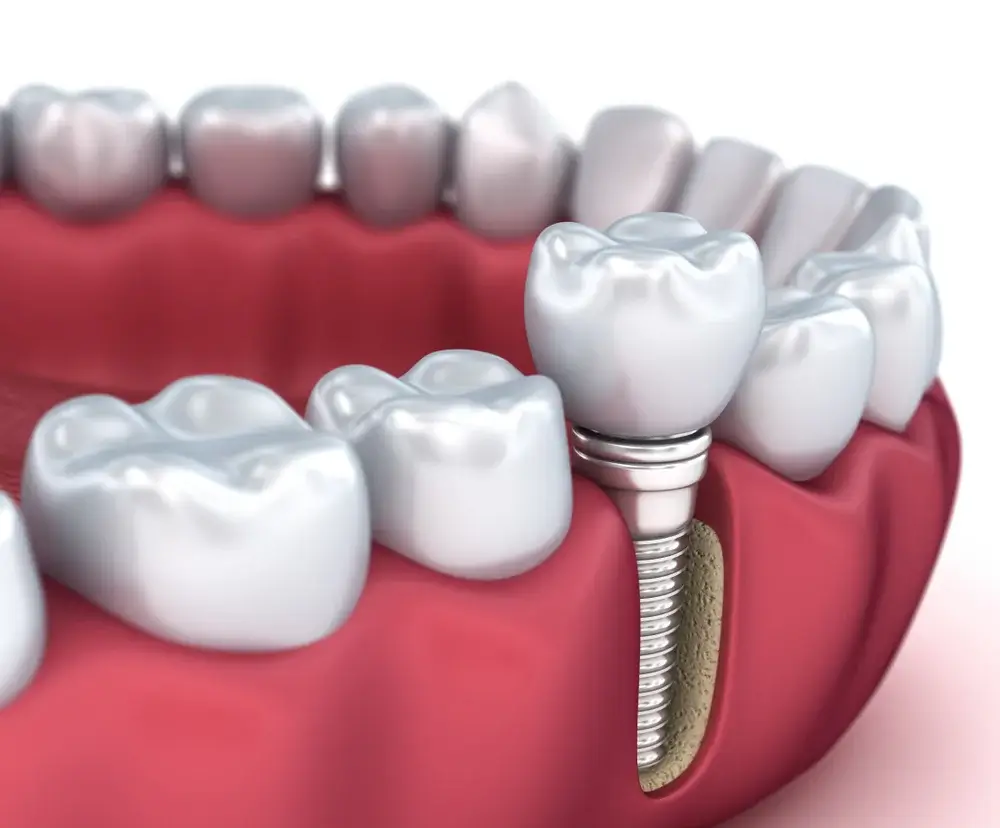 Woodbridge, ON area dentist describes the purpose of root canals treatment