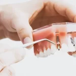 Vaughan Dentist Offers Dental Implants To Replace Missing Teeth And Restore Smile