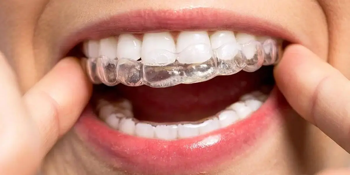 Woodbridge, ON dental practice offers invisible braces to straighten teeth