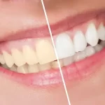 Where can I find laser teeth whitening near me in Woodbridge, ON?