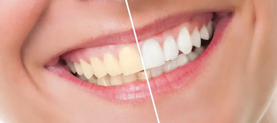 Where can I find laser teeth whitening near me in Woodbridge, ON?
