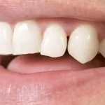Patients Near Our Vaughan Dental Clinic Learn About Gum Recession
