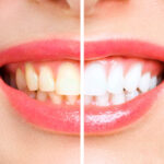 teeth whitening Woodbridge