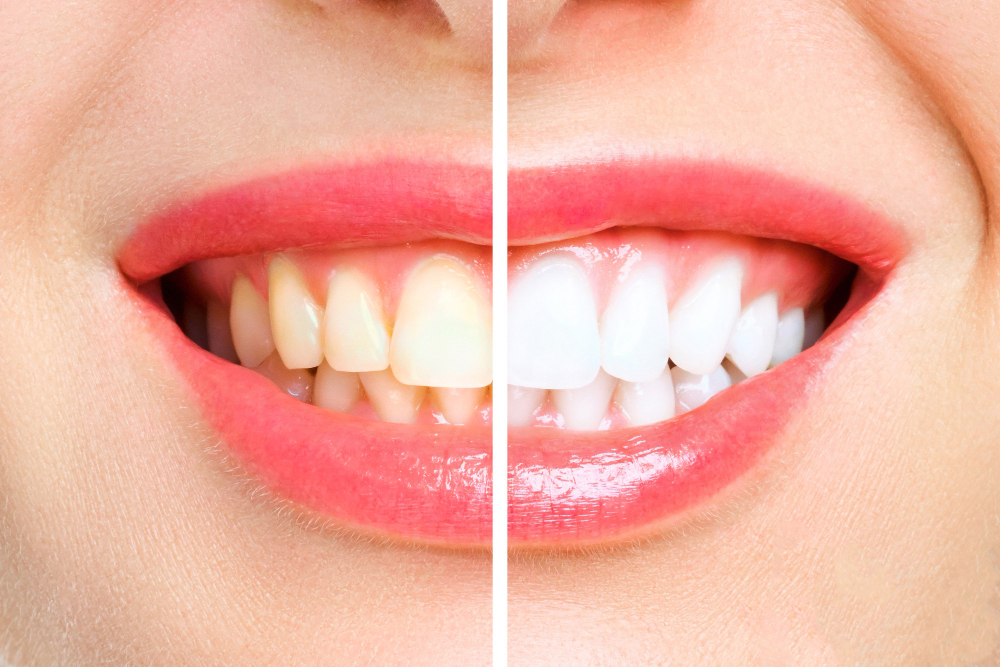 teeth whitening Woodbridge