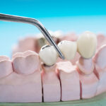 dental crowns woodbridge