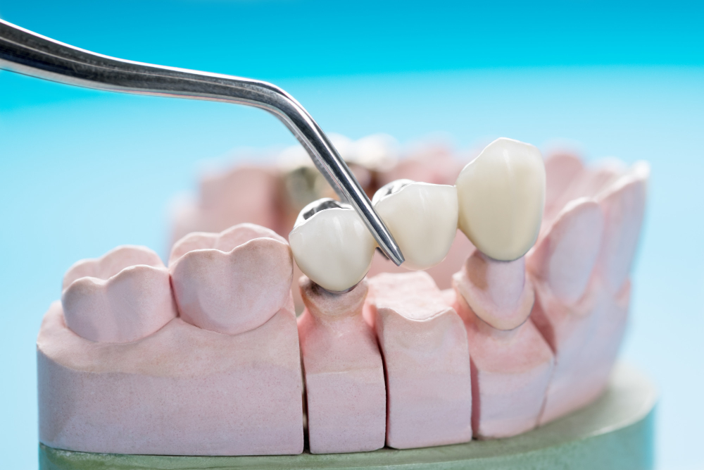dental crowns woodbridge