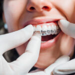 invisalign woodbridge
