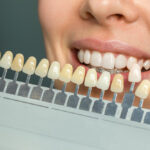 porcelain veneers woodbridge