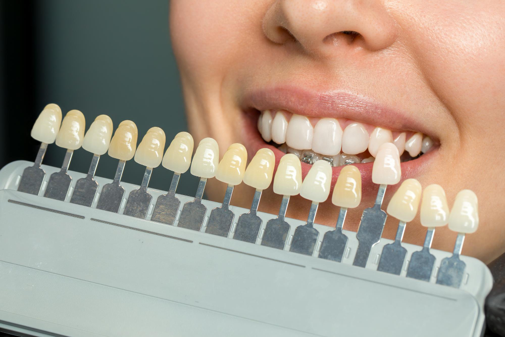 porcelain veneers woodbridge